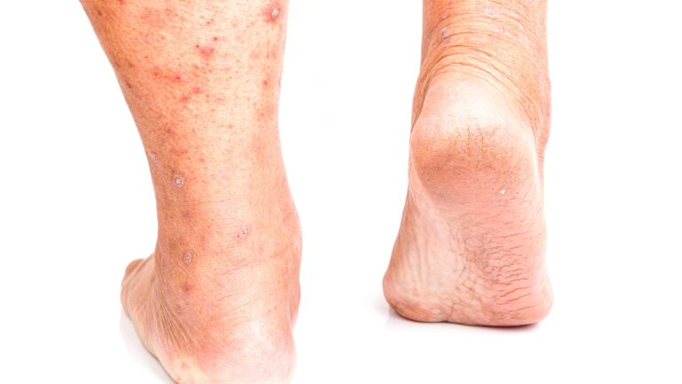 Farmacodermia: o que é, aspectos clínicos e mais!