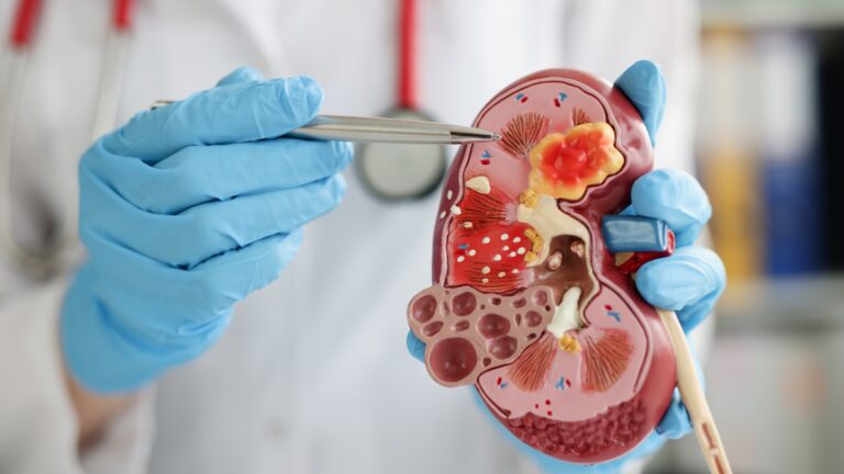 Síndrome de Nutcracker: entenda o que é, como diagnosticar e tratar