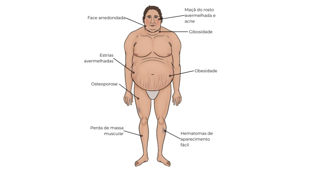 Ilustração médica de paciente com sinais clássicos da síndrome de Cushing, incluindo obesidade central, face arredondada, acne, giba, estrias avermelhadas, perda de massa muscular, osteoporose e hematomas frequentes.