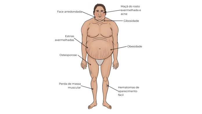 Síndrome de Cushing: o que é, como identificar e mais! Ilustração médica de paciente com sinais clássicos da síndrome de Cushing, incluindo obesidade central, face arredondada, acne, giba, estrias avermelhadas, perda de massa muscular, osteoporose e hematomas frequentes.
