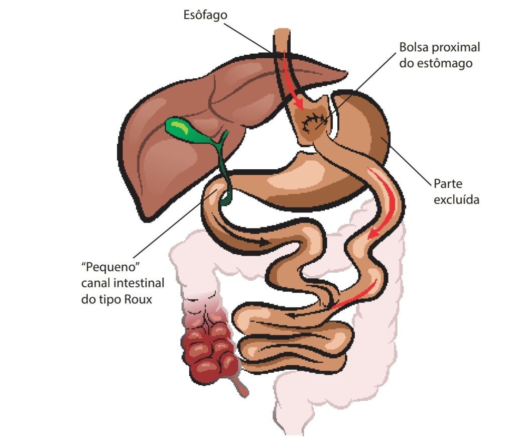 Ilustração de cirurgia bariátrica bypass gástrico em Y de Roux, mostrando o esôfago ligado à bolsa proximal do estômago, a parte excluída do estômago e o pequeno canal intestinal em Y.