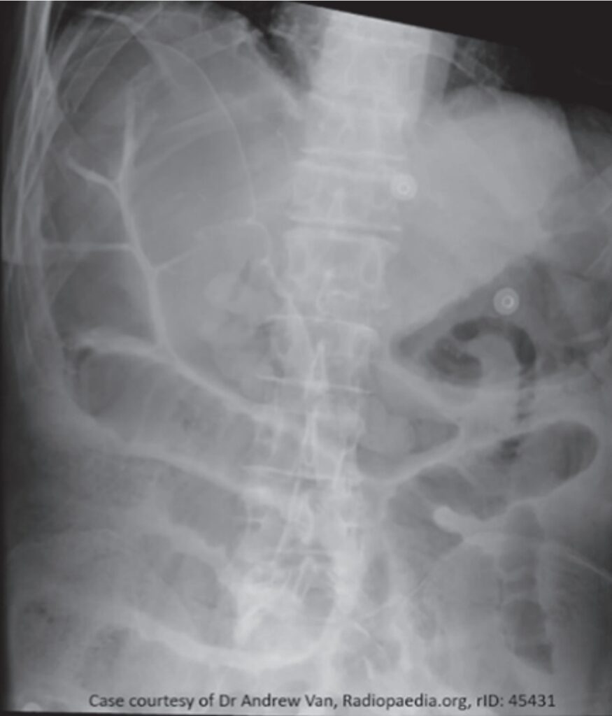 Radiografia abdominal mostrando o sinal de Rigler, com presença de ar delineando as alças intestinais.