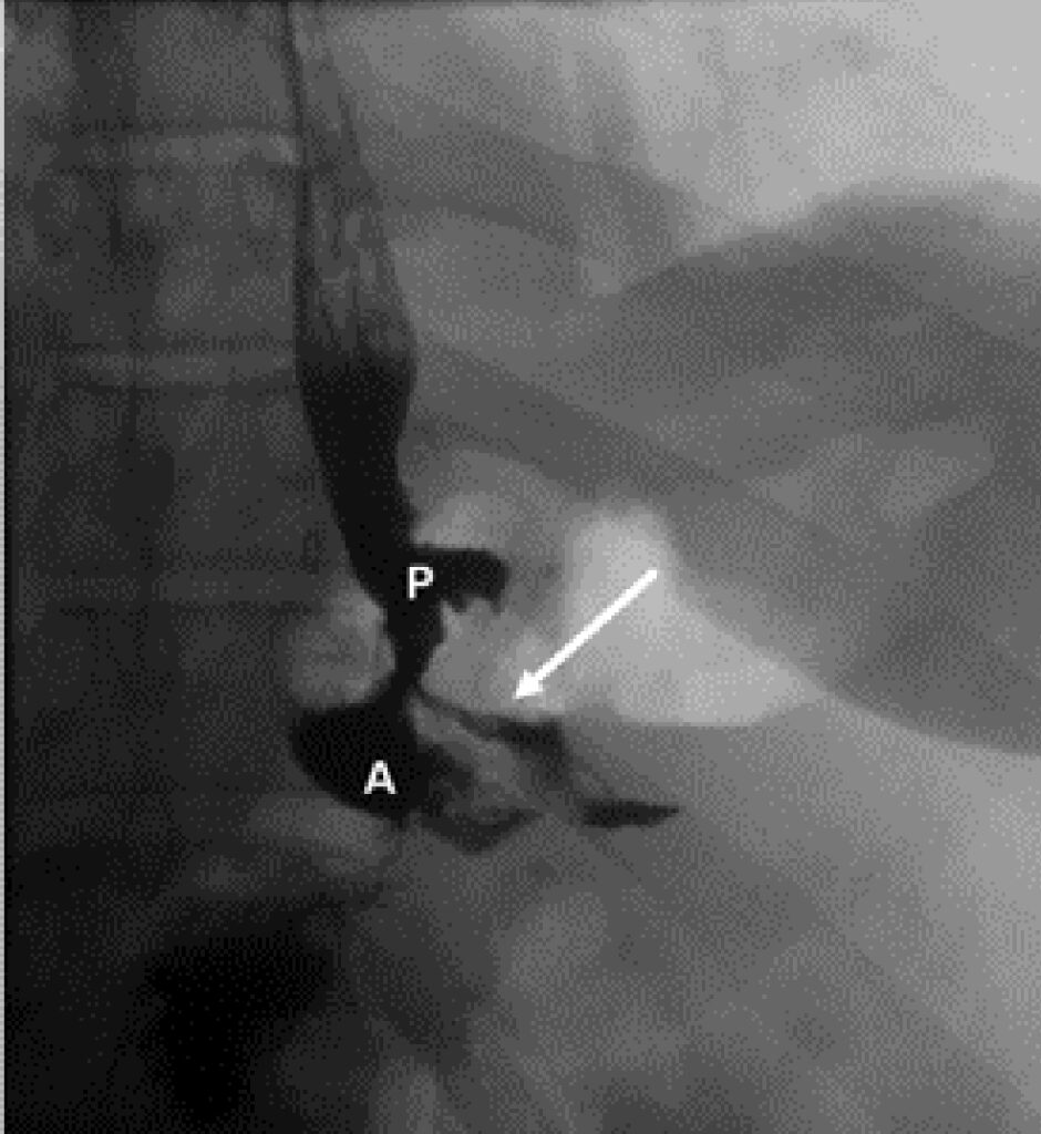 Imagem radiográfica com contraste mostrando fístula entre o pouch gástrico e cavidade adjacente após cirurgia bariátrica.
