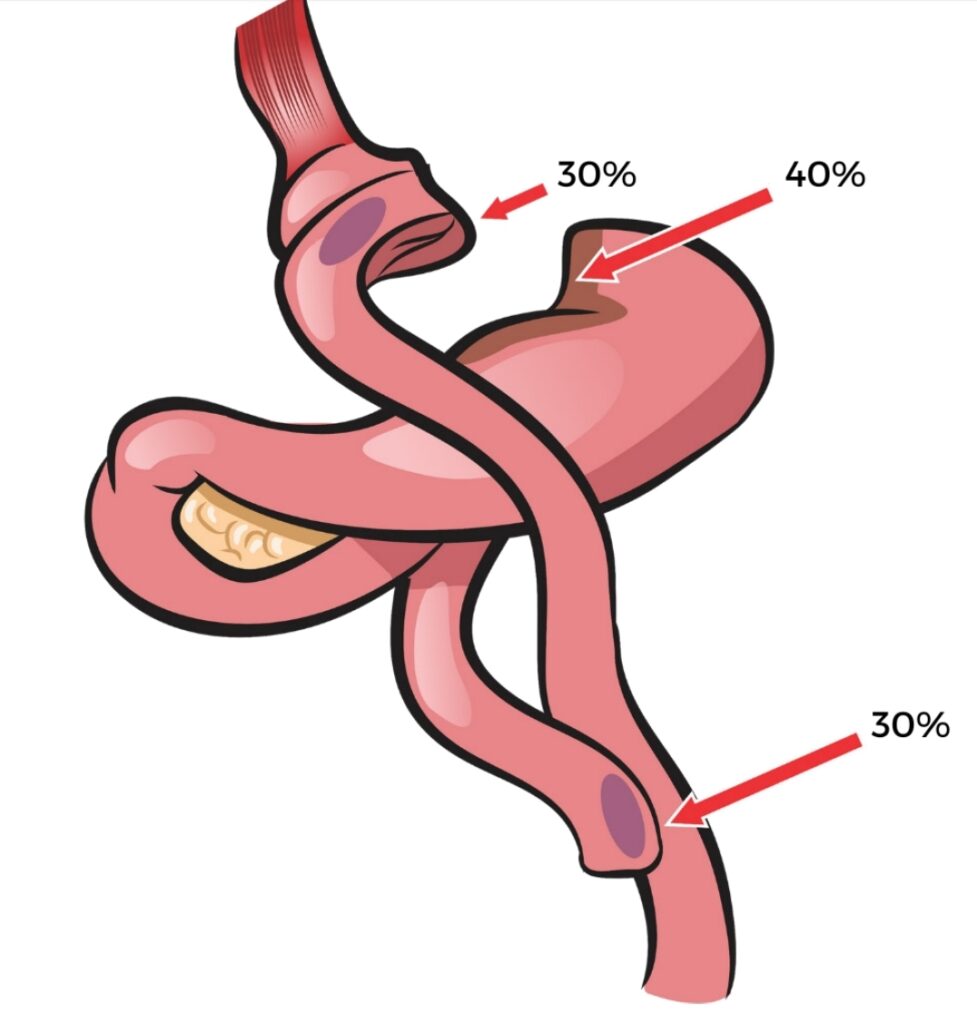 Ilustração do trato digestivo após cirurgia bariátrica tipo bypass gástrico, destacando locais e porcentagens de risco de sangramento pós-operatório (40% no estômago e 30% em duas regiões do intestino).
