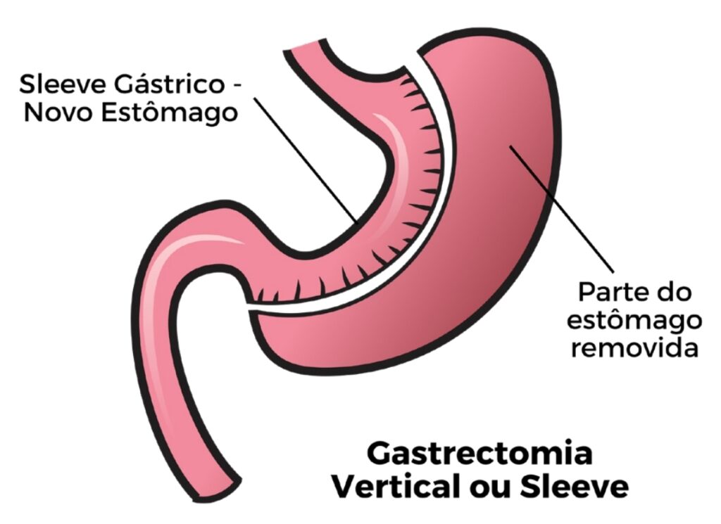 Ilustração da gastrectomia vertical em sleeve, mostrando o novo estômago em formato tubular e a parte do estômago removida na cirurgia bariátrica.