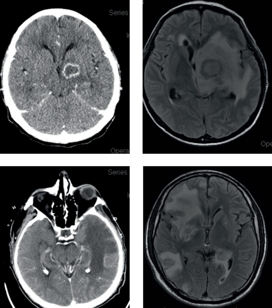 Tomografias computadorizadas e ressonâncias magnéticas de crânio mostrando lesões anelares nos gânglios da base e em outras regiões cerebrais.