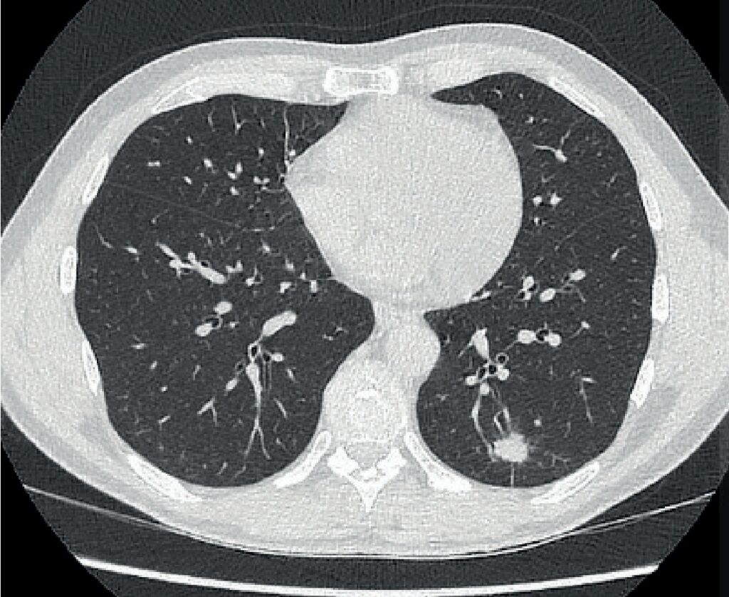 Tomografia computadorizada de tórax mostrando nódulos e micronódulos subpleurais compatíveis com acometimento pulmonar por criptococose.