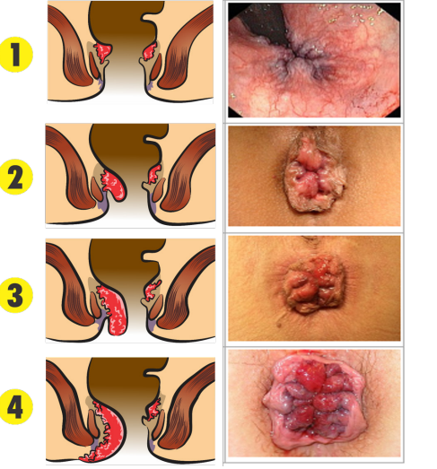Ilustração e fotografias médicas mostrando os quatro graus de hemorroidas internas, de acordo com a presença e gravidade do prolapso.