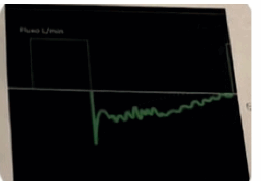 Monitor multiparamétrico exibindo curvas de pressão, fluxo e volume em paciente sob ventilação mecânica.