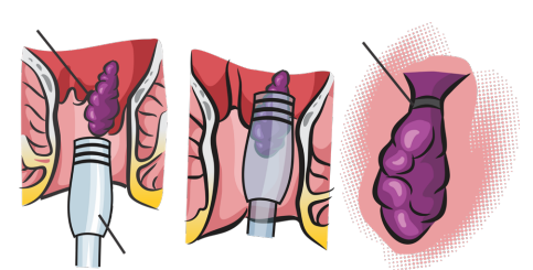 Ilustração médica mostrando o procedimento de ligadura elástica de hemorroidas internas em três etapas.
