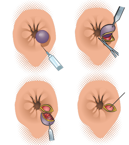 Ilustração médica em quatro etapas demonstrando a técnica aberta de Milligan-Morgan para hemorroidectomia.