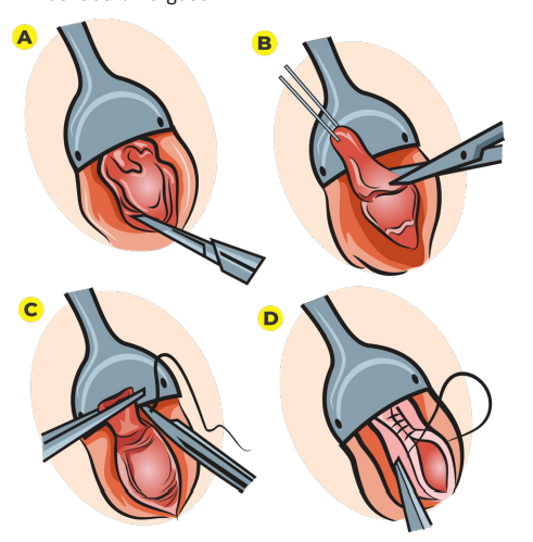 Ilustração médica em quatro etapas mostrando a técnica fechada de Ferguson para tratamento cirúrgico de hemorroidas.