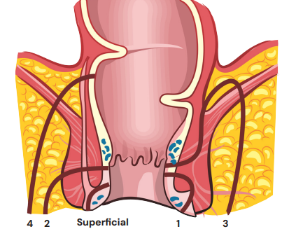 Ilustração médica mostrando a classificação de Parks para fístulas anais, com diferentes trajetos fistulosos numerados de 1 a 4, além da representação superficial.