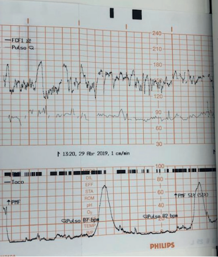 Gráfico de cardiotocografia exibindo a frequência cardíaca fetal na parte superior e as contrações uterinas na parte inferior.