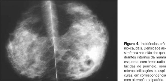 Representação de mamografia com mastite granulomatosa idiopática.