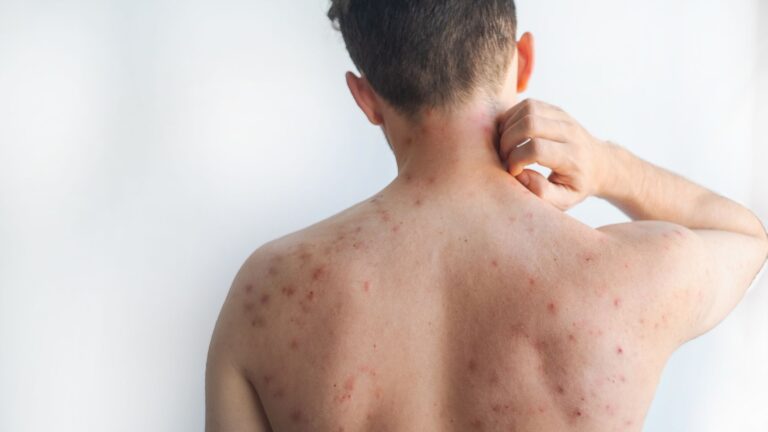 sarampo, sarampo sintomas, sintomas de sarampo, manchas de koplik, vírus do sarampo, doenças exantematicas, exantema
