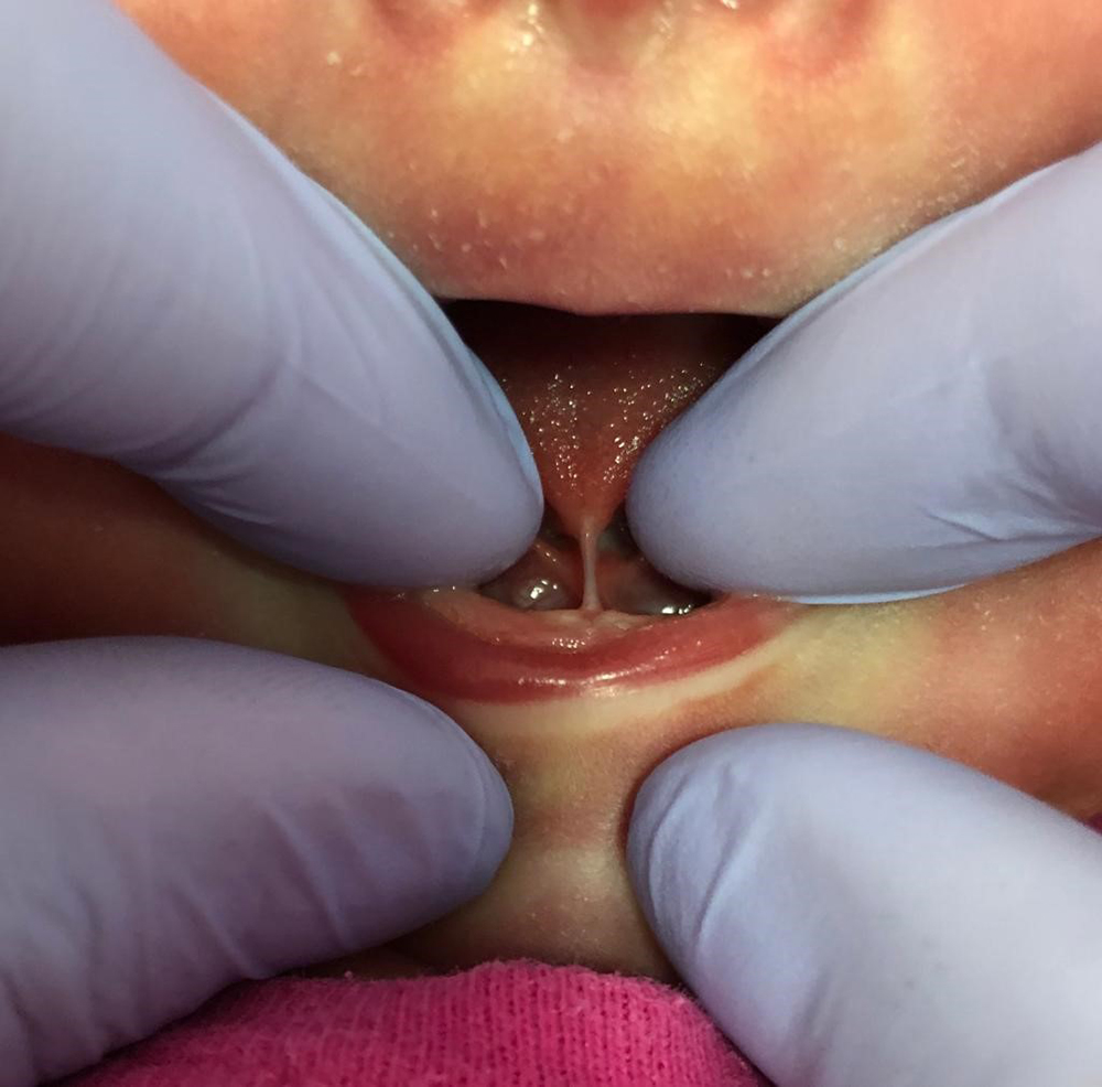 Anquiloglossia como causa da mastite durante a amamentação.