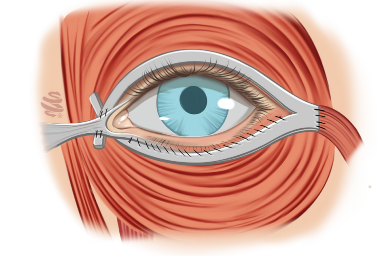 Ilustração de retalho temporal para correção dinâmica do fechamento palpebral.
