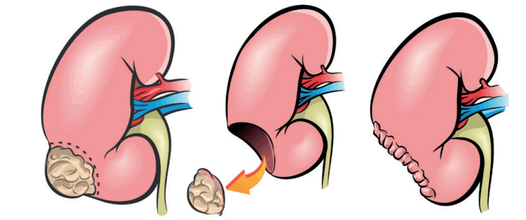 Etapas de cirurgia citoredutora renal mostrando remoção do tumor e sutura do rim após ressecção.