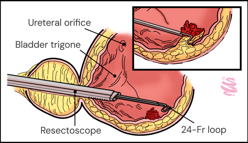 Procedimento endoscópico com ressectoscópio e alça de 24-Fr para biópsia da bexiga em diagnóstico anatomopatológico.