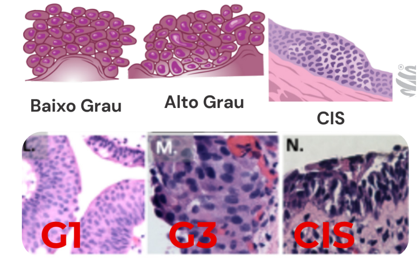 Comparação microscópica dos graus de desorganização celular em câncer de bexiga: baixo grau (G1), alto grau (G3) e carcinoma in situ (CIS).
