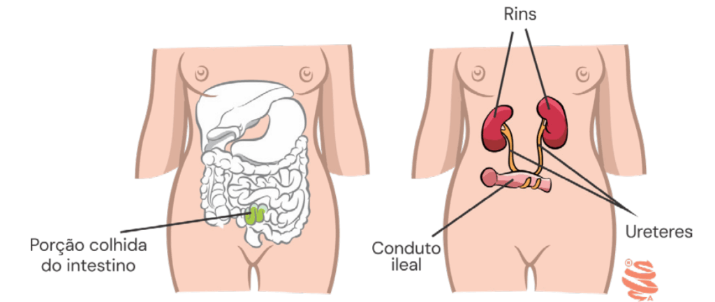 Ilustração médica do conduto ileal tipo Bricker mostrando a retirada de segmento intestinal e sua conexão com ureteres para derivação urinária.