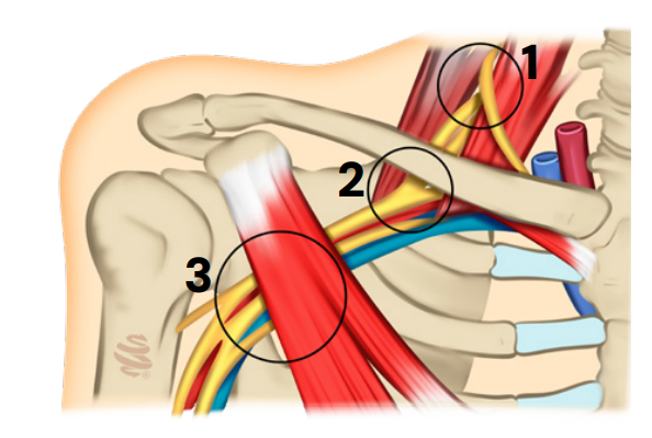 Ilustração médica mostrando as principais causas da síndrome do desfiladeiro torácico, com três regiões circuladas onde pode ocorrer compressão de nervos e vasos sanguíneos entre músculos, costelas e clavícula.