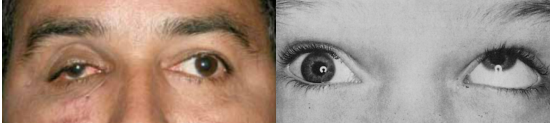 Olhos com encarceramento do músculo reto inferior.