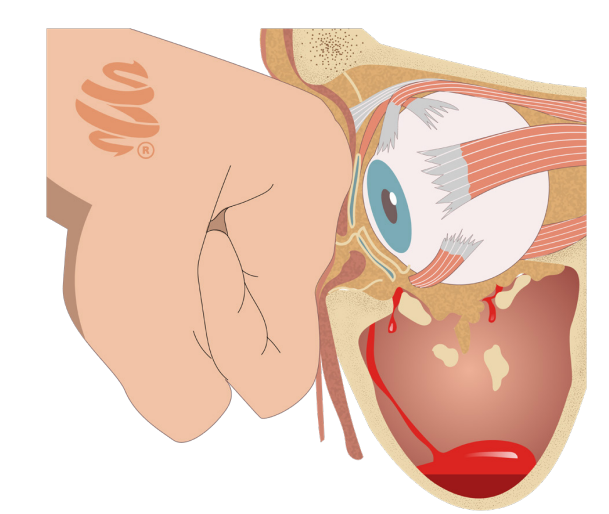 Representação de hematoma retrobulbar após trauma ocular.