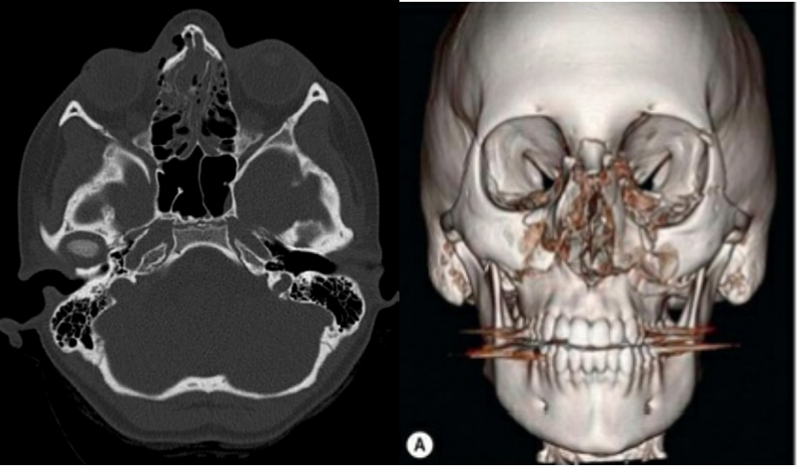 Tomografia e reconstrução 3D mostrando trauma facial do subtipo NOE.