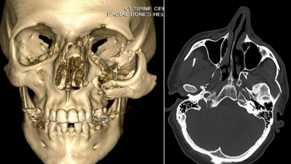 Reconstrução 3D e tomografia de trauma de zigoma.