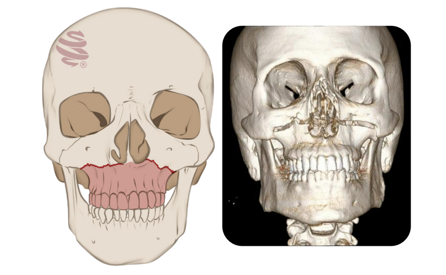 Ilustração e tomografia mostrando fratura facial do tipo Le Fort I.