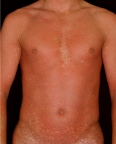 Rash cutâneo ao exame de mononucleose infecciosa associada à amoxicilina.