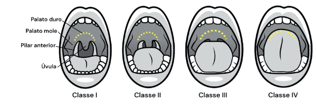 Ilustração da Classificação de Mallampati, mostrando as classes I a IV conforme a visibilidade da úvula e do palato, usada para prever dificuldade de intubação.