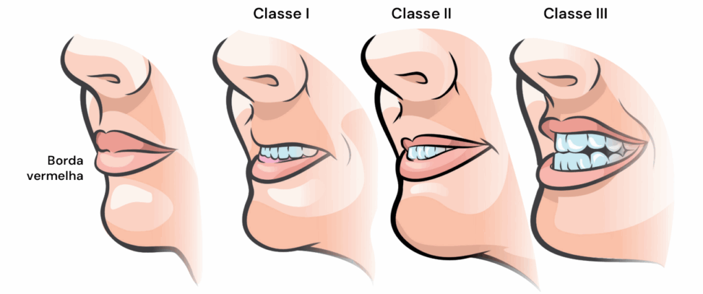 Ilustração do Upper Lip Bite Test, apresentando as classes I, II e III, conforme a capacidade do paciente de morder o lábio superior — teste para prever via aérea difícil.