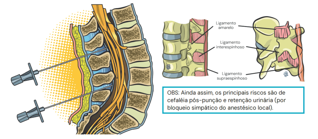 Raquianestesia e Peridural: Entenda o controle do NeuroEixo para as ...