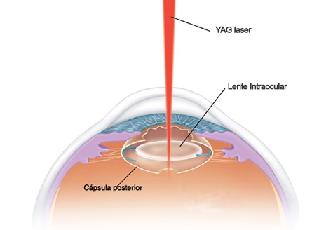 Capsulotomia YAG-Laser