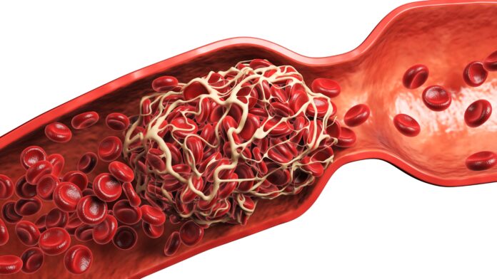 Tromboelastograma: Entenda a Hemostasia Viscoelástica para a Prática Médica Avançada