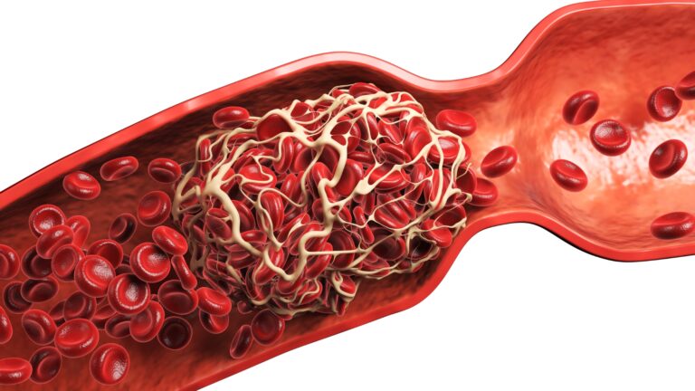 Tromboelastograma: Entenda a  Hemostasia Viscoelástica para a Prática Médica Avançada