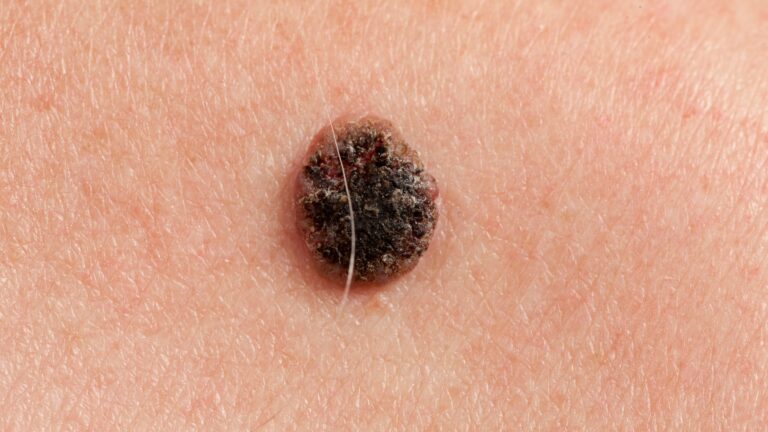 Entenda sobre o Carcinoma Espinocelular de Trato Aerodigestivo Superior