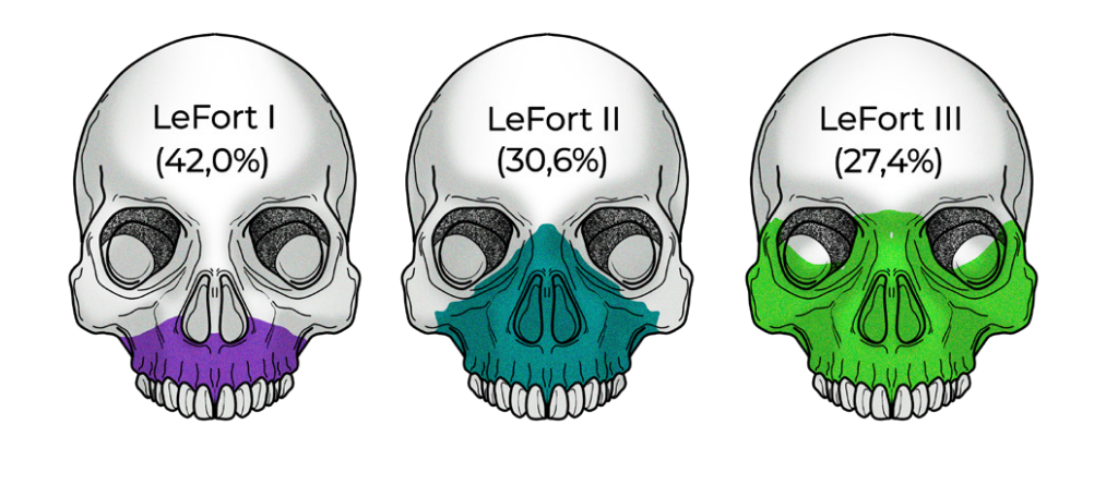 Ilustração da classificação de LeFort para fraturas da face.