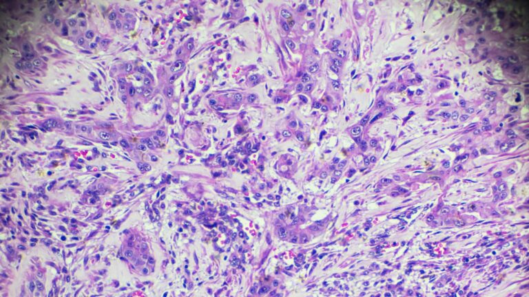 Carcinoma Hepatocelular: do rastreio ao transplante