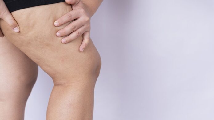 Revalida (18) lipedema