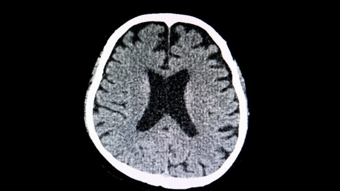Neurorradiologia: o que é, o que faz, residência médica e salários