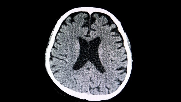 Neurorradiologia: o que é, o que faz, residência médica e salários