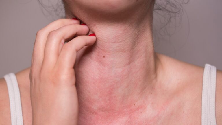 Dermatomiosite: o que é, sintomas, tratamento e associação com câncer