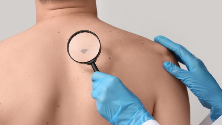 Dermatopatologia: o que é, padrões histológicos, biópsia e diagnóstico