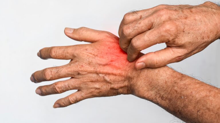 Dermatologia sanitária: doenças epidemiológicas e atuação no SUS