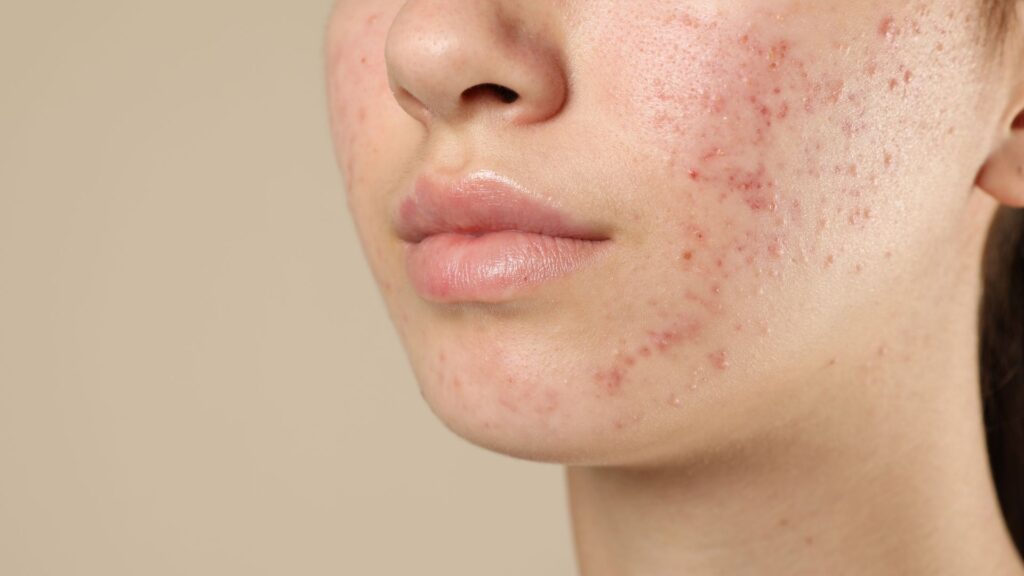 dermatologia clínica | Imagem: Pessoa de pele branca, jovem, em plano de detalhe (close-up) focado na metade inferior do rosto, exibindo a bochecha esquerda, o nariz, os lábios e o queixo. A pele apresenta um quadro acentuado de acne inflamatória, caracterizado por múltiplas pápulas e pústulas avermelhadas concentradas principalmente na região da bochecha e estendendo-se pela linha da mandíbula e queixo. Os poros estão visíveis e há áreas com leve brilho e textura irregular.