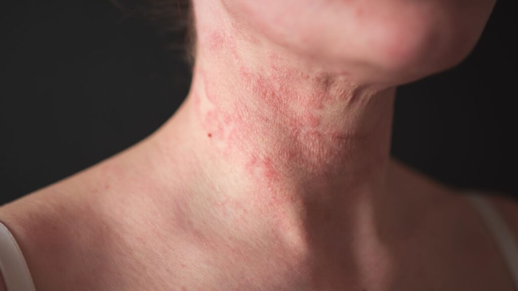 dermatologia clínica | Imagem: Pessoa de pele branca, em plano de detalhe (close-up) focado na região do pescoço, colo e parte inferior do queixo. A pele apresenta uma reação dermatológica intensa, caracterizada por placas e manchas avermelhadas (eritematosas), salientes e de textura áspera, concentradas principalmente na lateral e na parte frontal do pescoço. Há sinais de descamação fina e leve ressecamento sobre as lesões, compatíveis com um quadro de dermatite.